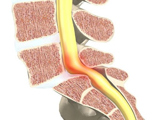 Osteoxondroz uchun qon-vosita segmenti