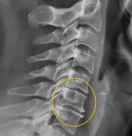 servikal osteoxondroz
