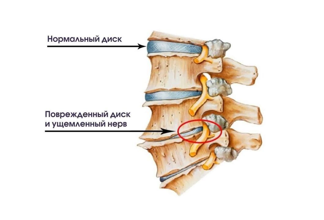 Servikal osteoxondrozning belgilari
